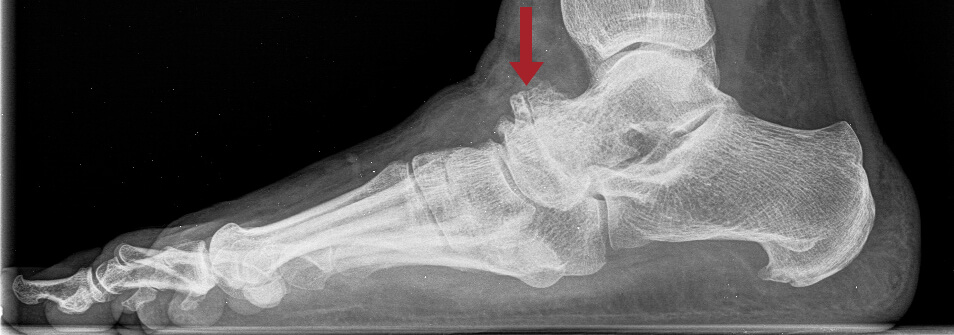 Fusswurzelarthrose-1 Röntgenbild einer Fusswurzelarthrose