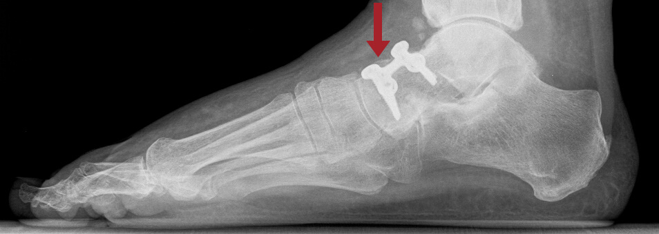 Fusswurzelarthrose-2 Röntgenbild einer Fusswurzelarthrose