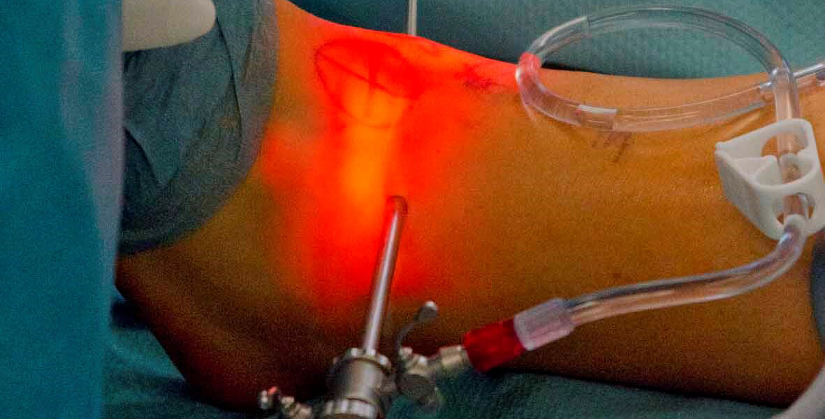Knorpelverletzungen-am-oberen-Sprunggelenk-1 Abbildung minimalinvasive Operation am Sprunggelenk