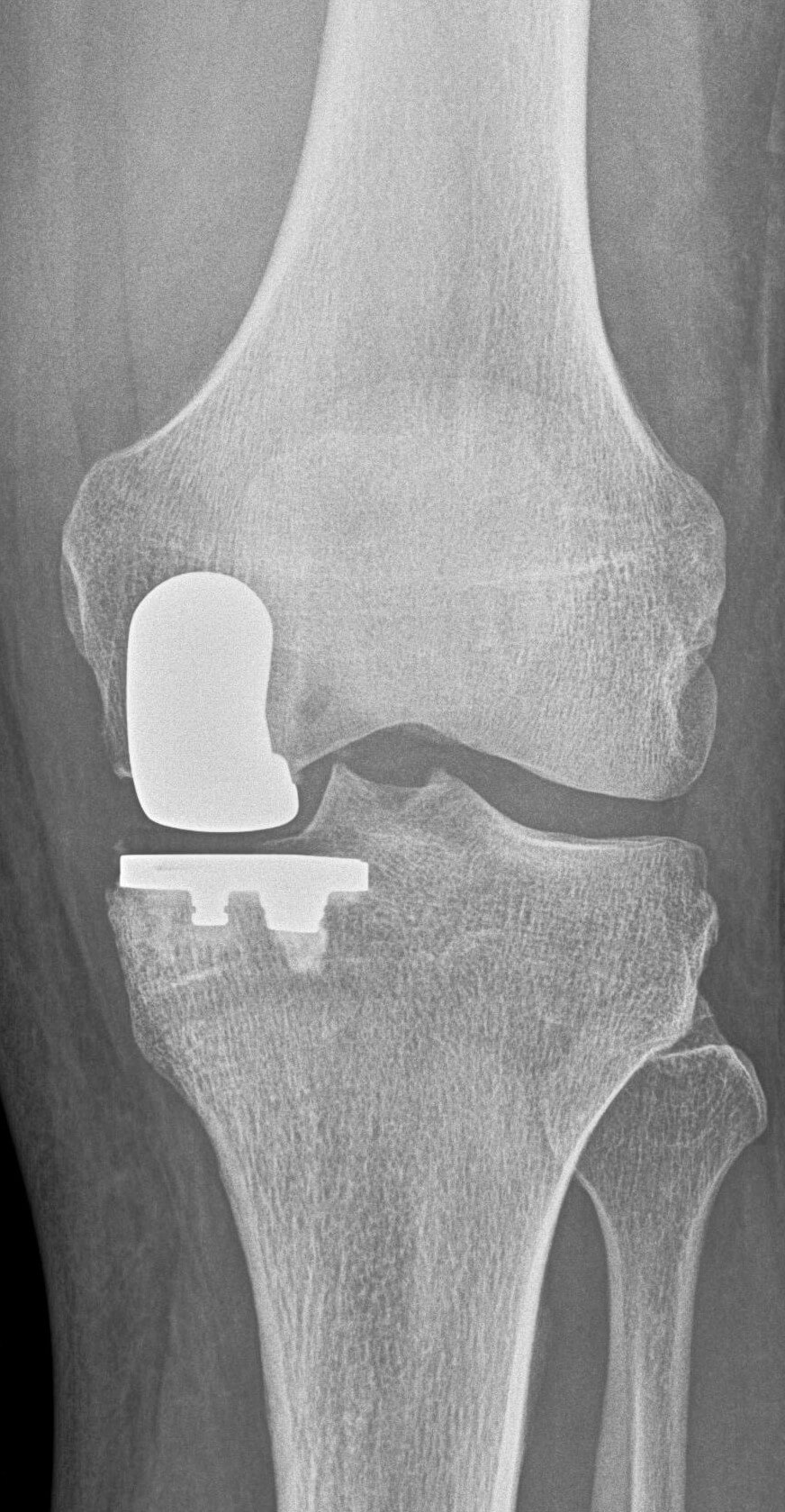 Röntgendbild Knie mit Arthrose