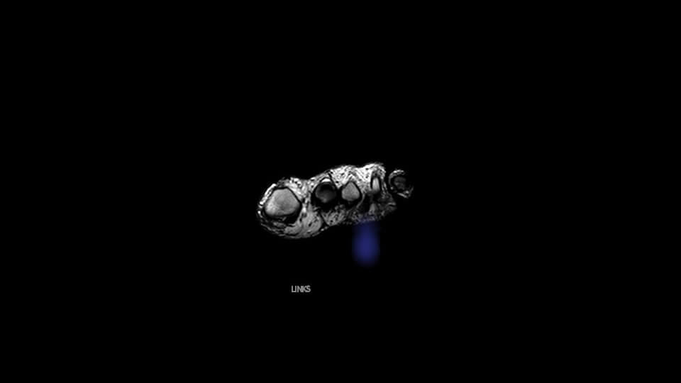3D Ultraschall eines Vorfusses